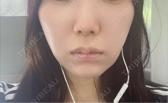 脂肪溶解注射（顔） Nクリニック伏見 DAY 6 メイン用