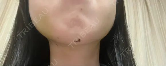 糸リフト / バッカルファット除去 / 脂肪吸引（顔） / ジョールファット除去 / ボトックス（エラ・小顔） アリエル美容クリニック 郡山院 DAY 24 メイン用