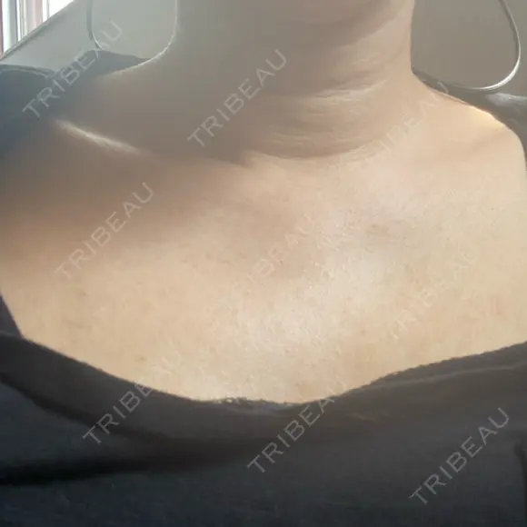 白玉点滴・注射 TCB東京中央美容外科 浜松院 DAY 23 メイン用