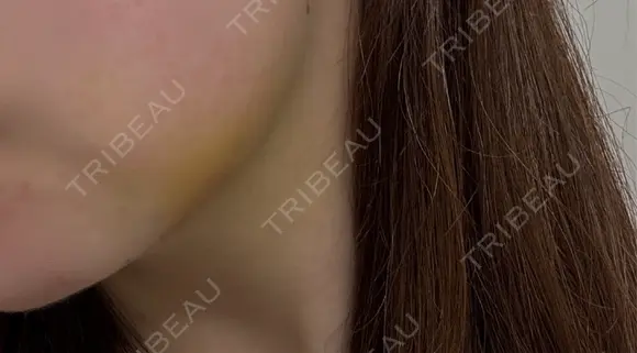 脂肪吸引（顔） ネビュラクリニック 京都院 DAY 5 メイン用