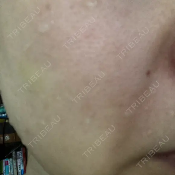 ショッピングリフト BAO CLINIC 梅田院 DAY 4 メイン用