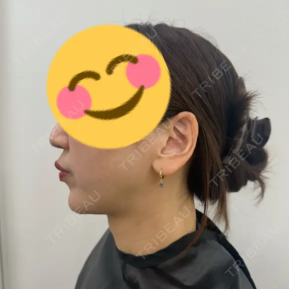 ショッピングリフト APスキンクリニック銀座 AFTER メイン用