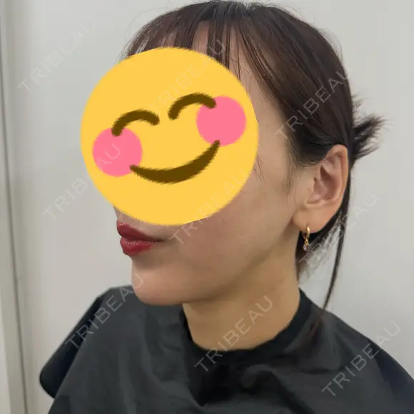 ショッピングリフト APスキンクリニック銀座 DAY 12 メイン用