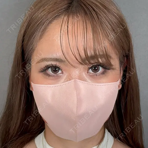 二重埋没 / 目頭切開 アリエル美容クリニック 大宮院 DAY 187 メイン用
