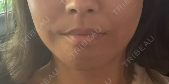 切開リフト / ワキ汗治療（切開） 石倉クリニック 水戸院 DAY 1 メイン用