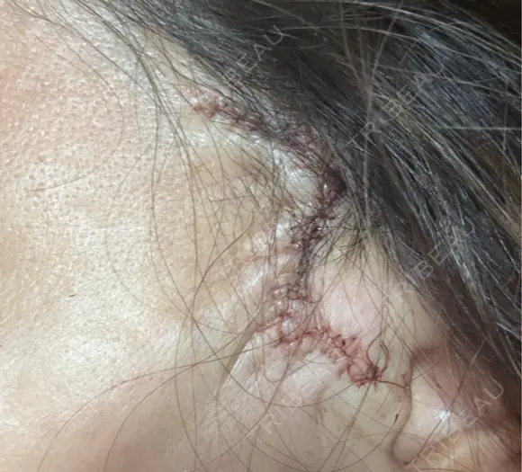 切開リフト / ワキ汗治療（切開） 石倉クリニック 水戸院 DAY 1 メイン用