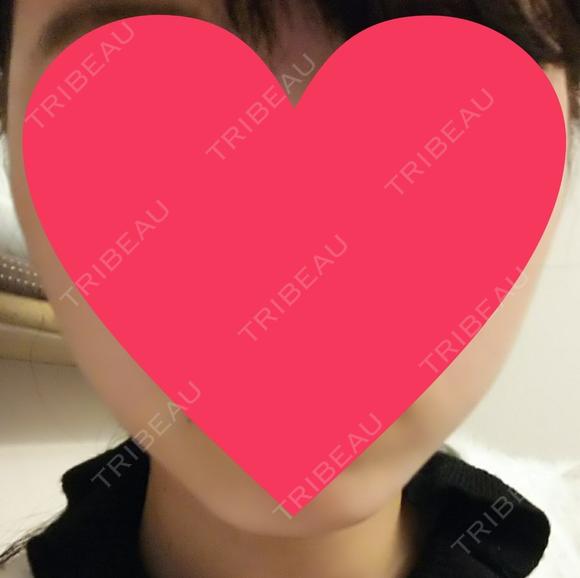 ハイフ（顔） 赤坂プレミアクリニック DAY 31 メイン用