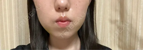 糸リフト / バッカルファット除去 / 脂肪吸引（顔） / ジョールファット除去 / ボトックス（エラ・小顔） アリエル美容クリニック 郡山院 DAY 26 メイン用