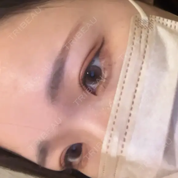 二重埋没 アリエル美容クリニック 郡山院 DAY 29 メイン用