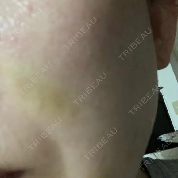 ショッピングリフト BAO CLINIC 梅田院 DAY 5 メイン用