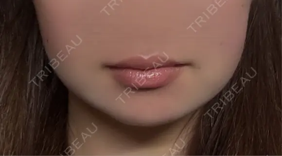 脂肪吸引（顔） ネビュラクリニック 京都院 DAY 7 メイン用