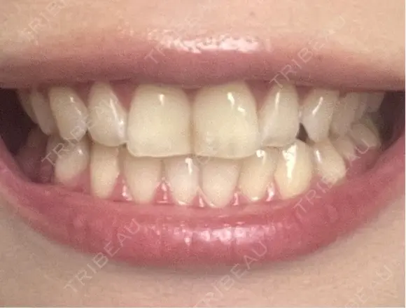 ホワイトニング 銀座本院 歯と美容のクリニック AFTER メイン用