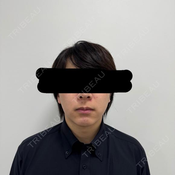 糸リフト / 脂肪吸引（顔） / 脂肪吸引注射（顔） / ヒアルロン酸注入（あご） SEA CLINIC（シークリニック） AFTER メイン用