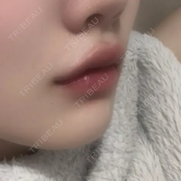 ヒアルロン酸注入（涙袋） / ヒアルロン酸注入（唇） / ボトックス（口角） ルラ美容クリニック 札幌本院 AFTER メイン用