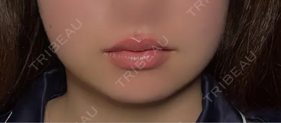 脂肪吸引（顔） ネビュラクリニック 京都院 DAY 9 メイン用