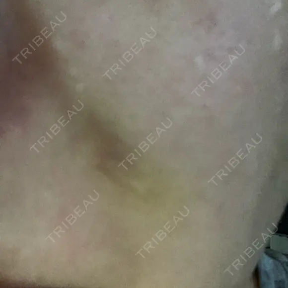 ショッピングリフト BAO CLINIC 梅田院 DAY 8 メイン用