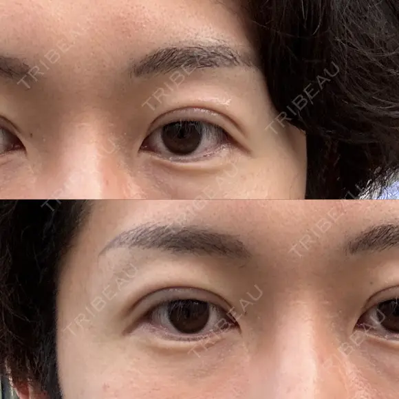 二重埋没 けやき美容クリニック 沼津院 DAY 0 メイン用