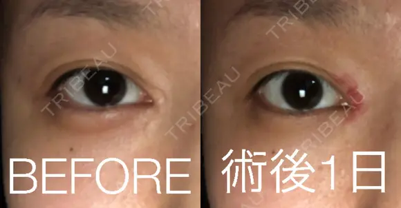 傷跡修正 / ほくろ・いぼ除去レーザー（肌） 山本クリニック DAY 1 メイン用