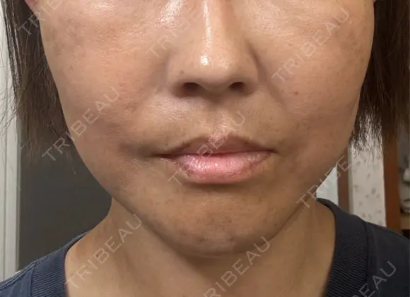 切開リフト / ワキ汗治療（切開） 石倉クリニック 水戸院 DAY 5 メイン用