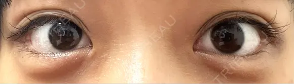 二重埋没 / ヒアルロン酸注入（涙袋） アリエル美容クリニック 横浜院 DAY 40 メイン用
