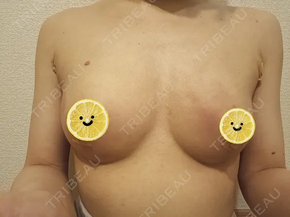 豊胸（脂肪注入） eクリニック 新宿院 DAY 0 メイン用