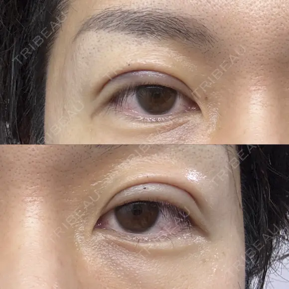 二重埋没 けやき美容クリニック 沼津院 DAY 1 メイン用