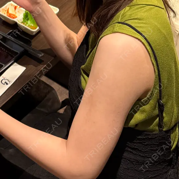 脂肪吸引（二の腕） Lipo Clinic omotesando DAY 108 メイン用