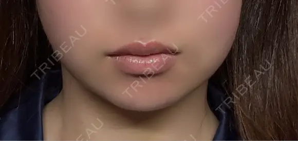 脂肪吸引（顔） ネビュラクリニック 京都院 DAY 11 メイン用