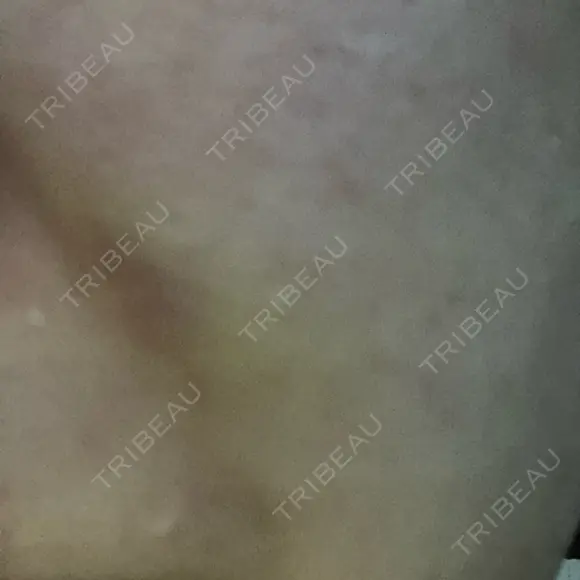 ショッピングリフト BAO CLINIC 梅田院 DAY 10 メイン用