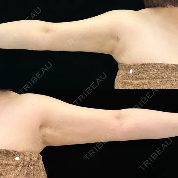 脂肪吸引（二の腕） EMMA CLINIC（エマクリニック） DAY 36 メイン用