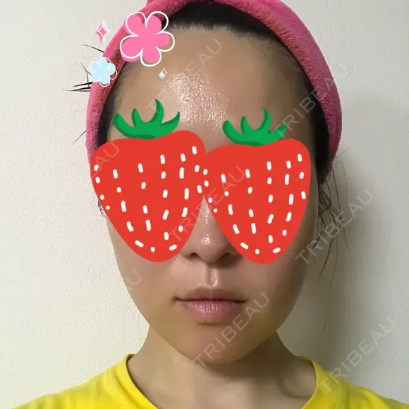 ボトックス（エラ・小顔） 湘南美容クリニック 京都院 DAY 4 メイン用