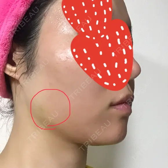 ボトックス（エラ・小顔） 湘南美容クリニック 京都院 DAY 4 メイン用
