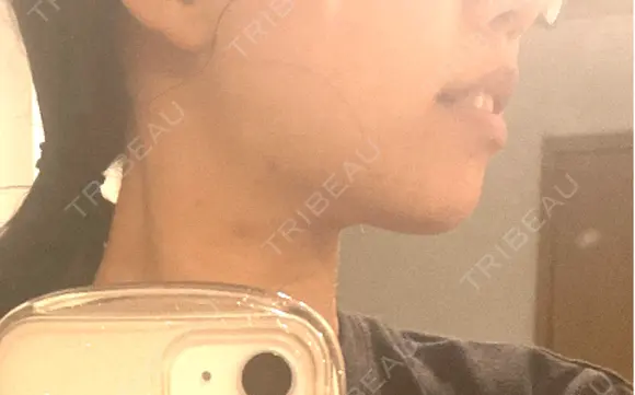 RF（高周波）たるみ治療 Wing clinic 豊中駅前院 DAY 0 メイン用