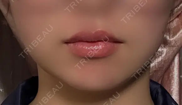 脂肪吸引（顔） ネビュラクリニック 京都院 DAY 13 メイン用