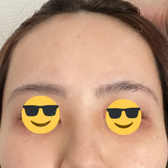 ピーリング（ハリ・ツヤ） FIG CLINIC DAY 1 メイン用