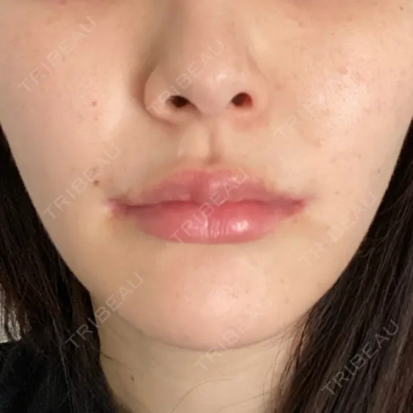 ピーリング（ハリ・ツヤ） FIG CLINIC DAY 1 メイン用