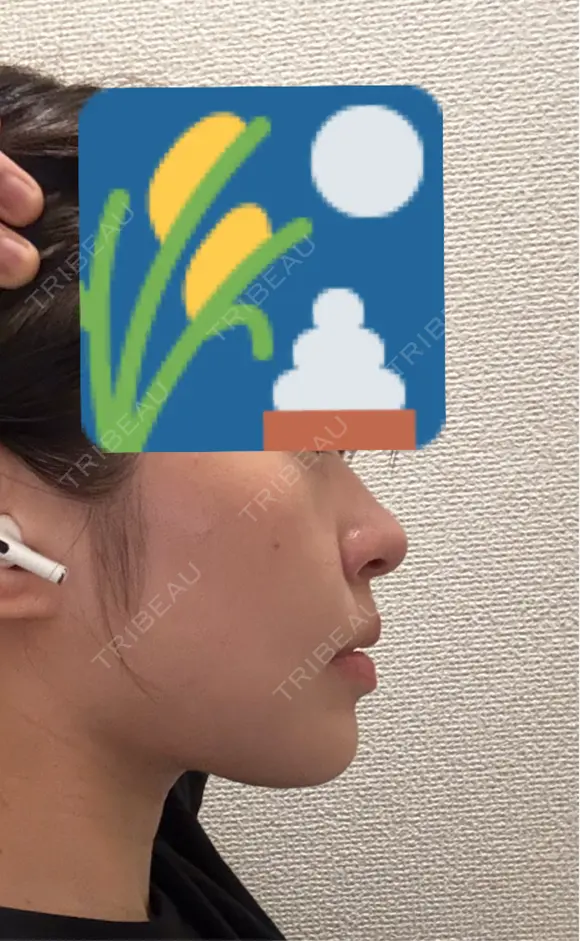 ボトックス（エラ・小顔） / ボトックス（口角） 銀座TAクリニック AFTER メイン用