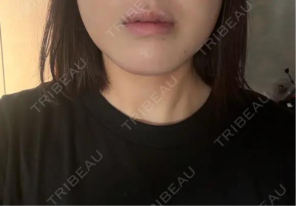 ハイフ（顔） AZ BEAUTY CLINIC DAY 0 メイン用