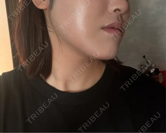 ハイフ（顔） AZ BEAUTY CLINIC DAY 0 メイン用