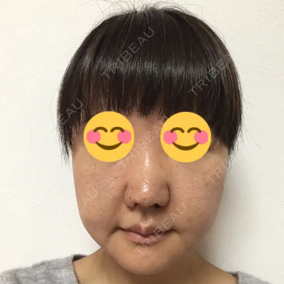 鼻尖形成（切開） / 小鼻縮小（切開） / 鼻尖縮小 湘南美容クリニック 神戸院 DAY 21 メイン用