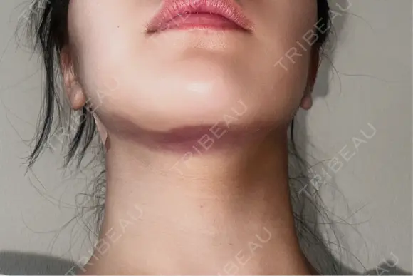 糸リフト / 脂肪吸引（顔） / ボトックス（エラ・小顔） A CLINIC（エークリニック） 新宿院 DAY 0 メイン用