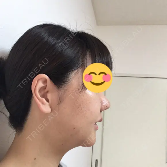 鼻尖形成（切開） / 小鼻縮小（切開） / 鼻尖縮小 湘南美容クリニック 神戸院 DAY 21 メイン用