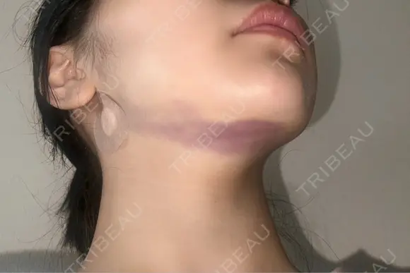 糸リフト / 脂肪吸引（顔） / ボトックス（エラ・小顔） A CLINIC（エークリニック） 新宿院 DAY 0 メイン用