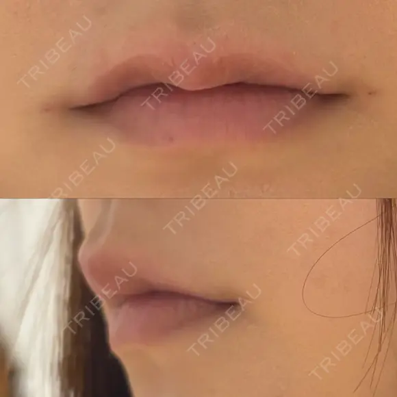 ヒアルロン酸注入（唇） / ボトックス（口角） ルラ美容クリニック 大阪心斎橋院 DAY 0 メイン用