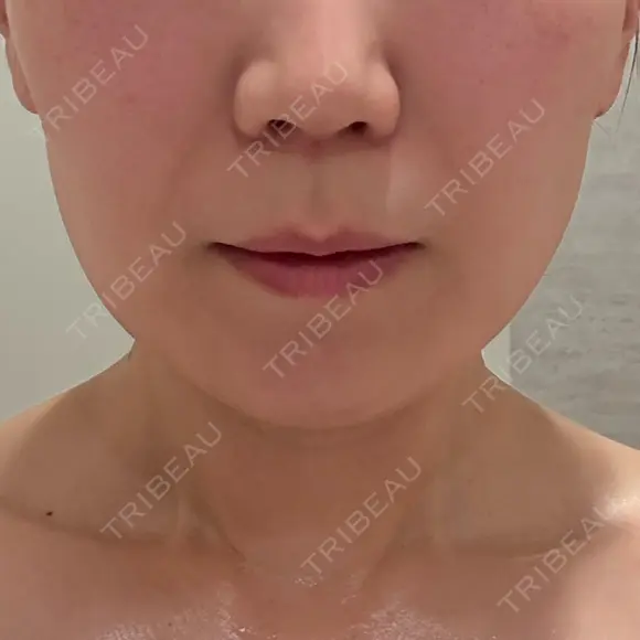 その他（肌） ルラ美容クリニック 仙台院 / ルラスキンクリニック 仙台院 AFTER メイン用