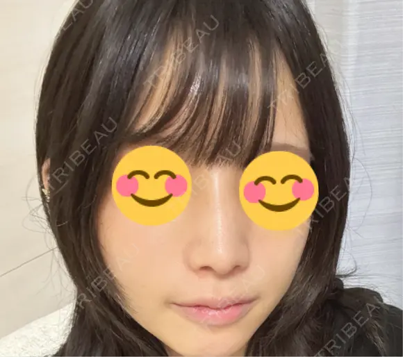 鼻尖形成（切開） / ワシ鼻修正・ハンプ切除 / 眉間プロテーゼ / 鼻柱下降・鼻唇角形成（猫手術） / ヒアルロン酸注入（額） グローバルビューティークリニック 大阪院 DAY 11 メイン用