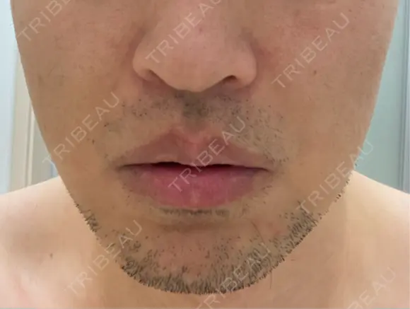 RF（高周波）たるみ治療 湘南美容クリニック 大阪梅田本院 DAY 2 メイン用