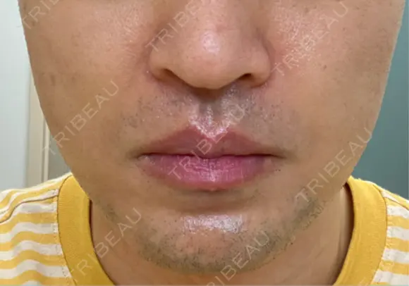 RF（高周波）たるみ治療 湘南美容クリニック 大阪梅田本院 DAY 3 メイン用