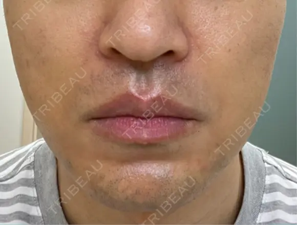 RF（高周波）たるみ治療 湘南美容クリニック 大阪梅田本院 DAY 4 メイン用