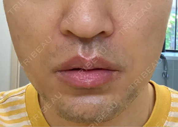 RF（高周波）たるみ治療 湘南美容クリニック 大阪梅田本院 DAY 5 メイン用